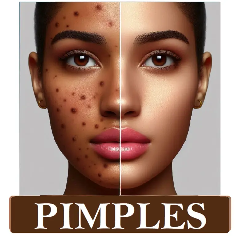 Natural Acne Scars Removal Kit - Luxury Giting