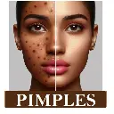 Natural Acne Scars Removal Kit - Luxury Giting