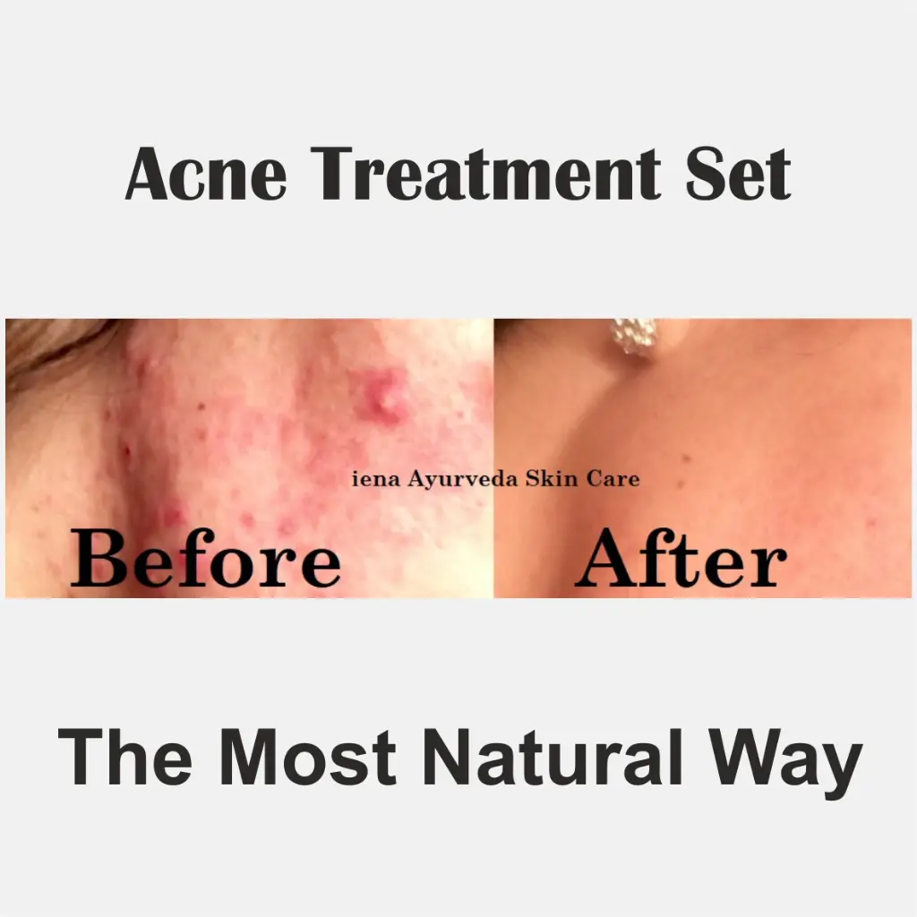 acne-kit-5.webp